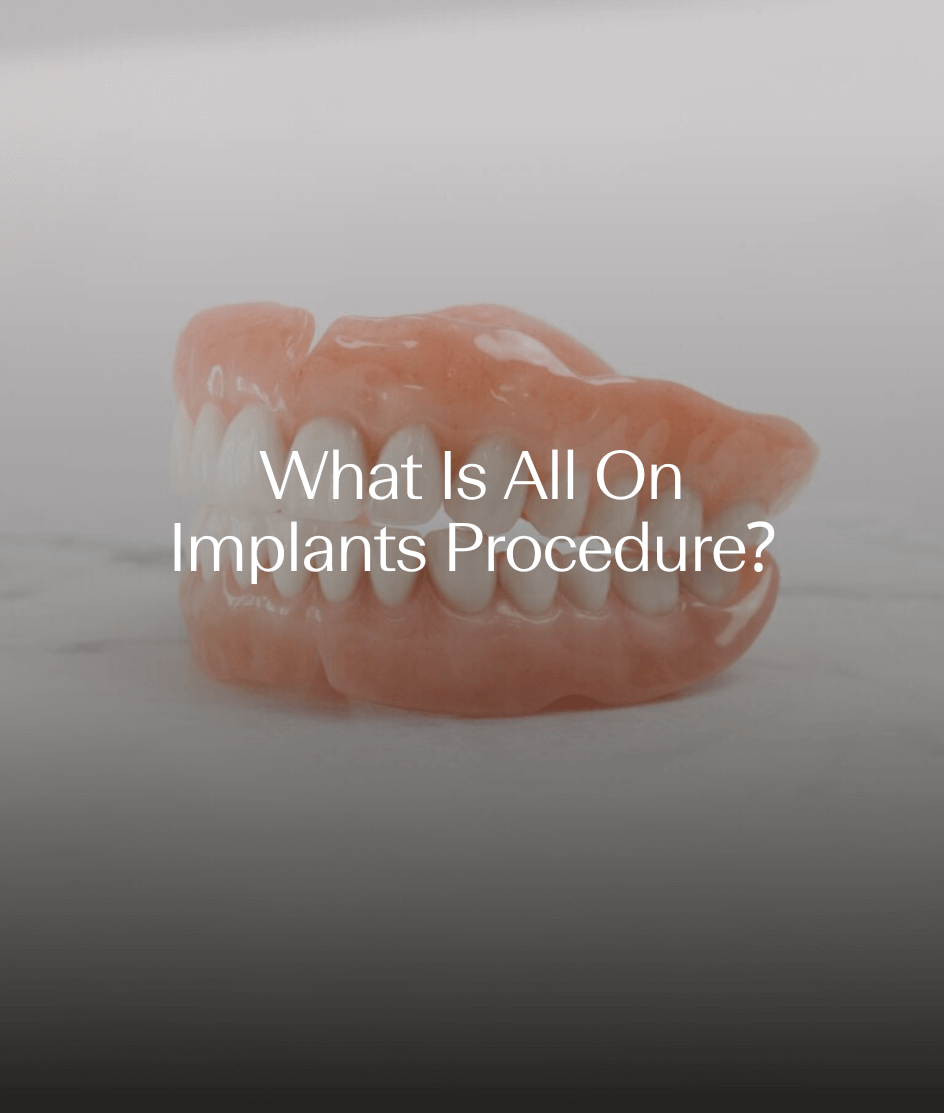 What Is All On Implants Procedure?